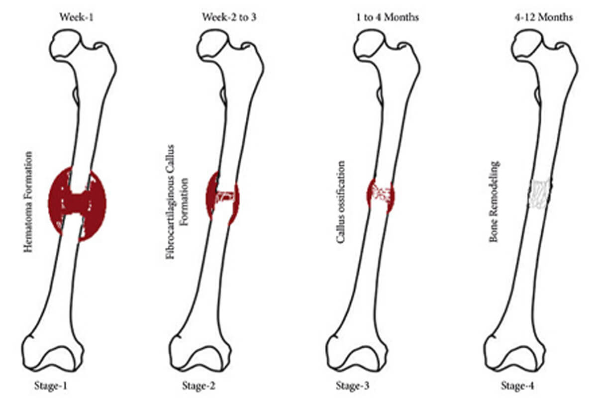 supplements for optimal bone healing after limb lengthening surgery 1