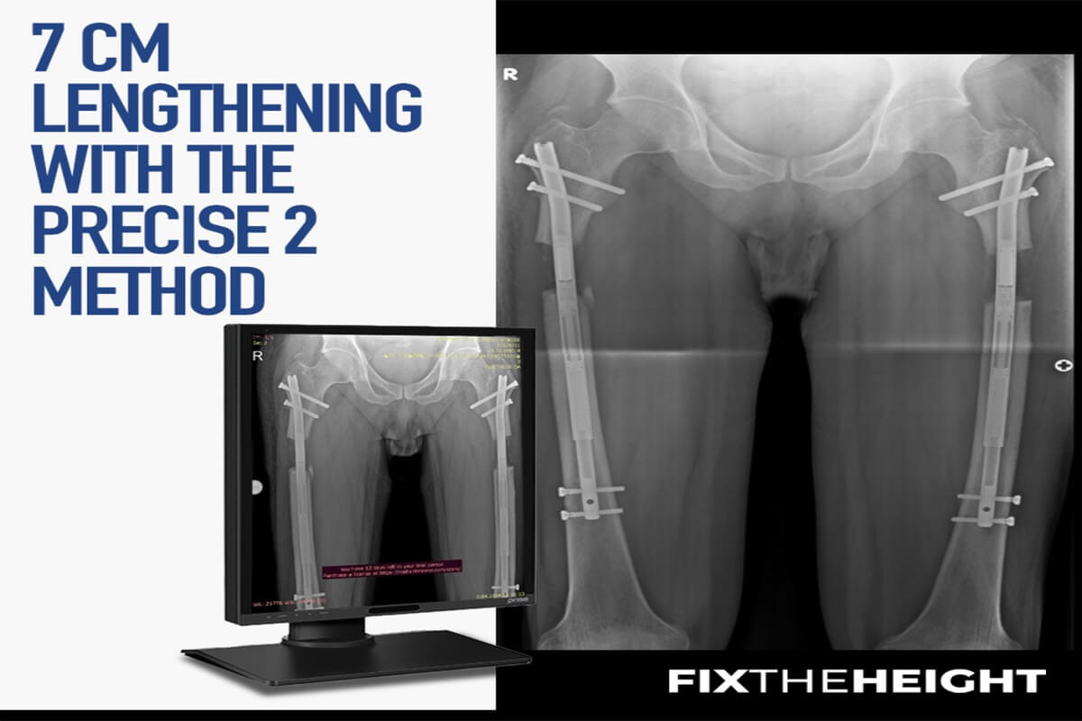 lengthening with the precise 2 method 1