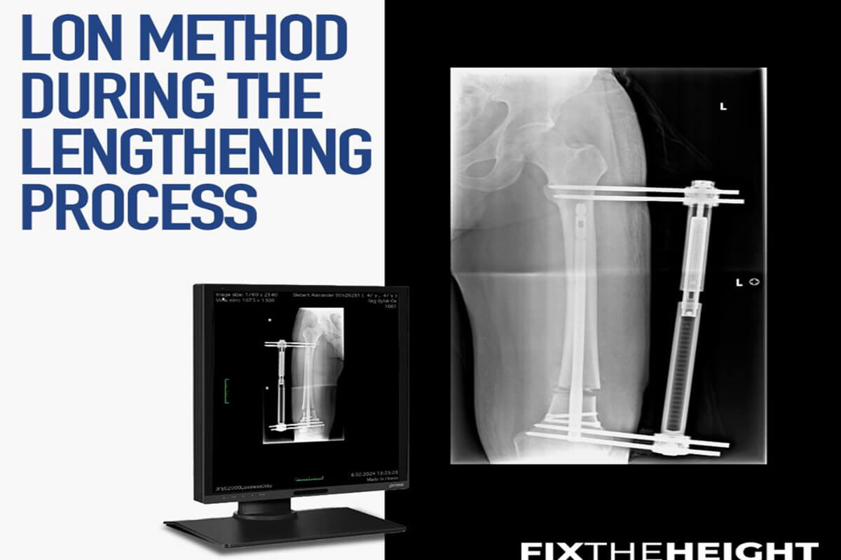 lon method during the lengthening process 1
