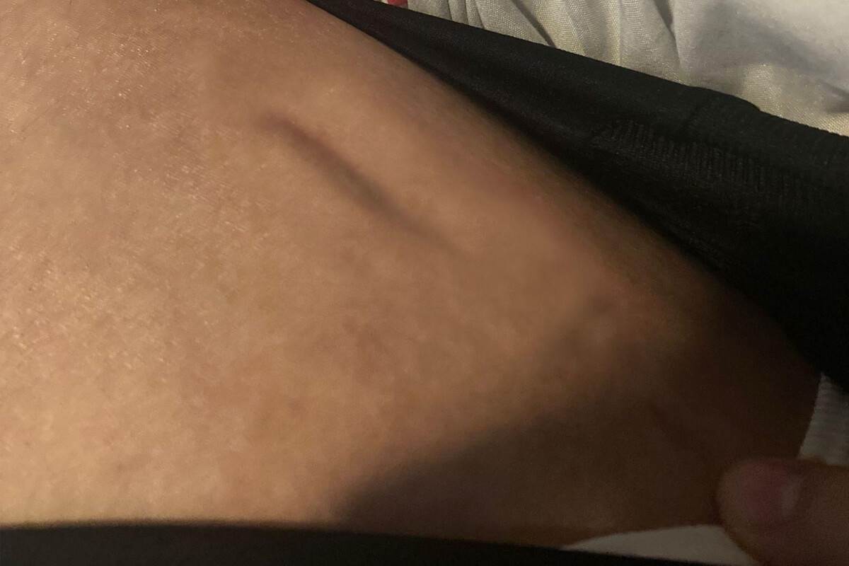 lon scar after 4 months from removal 1
