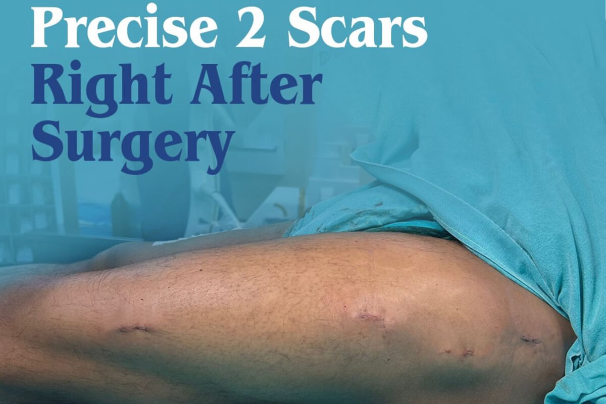 precise 2 scars right after surgery 1