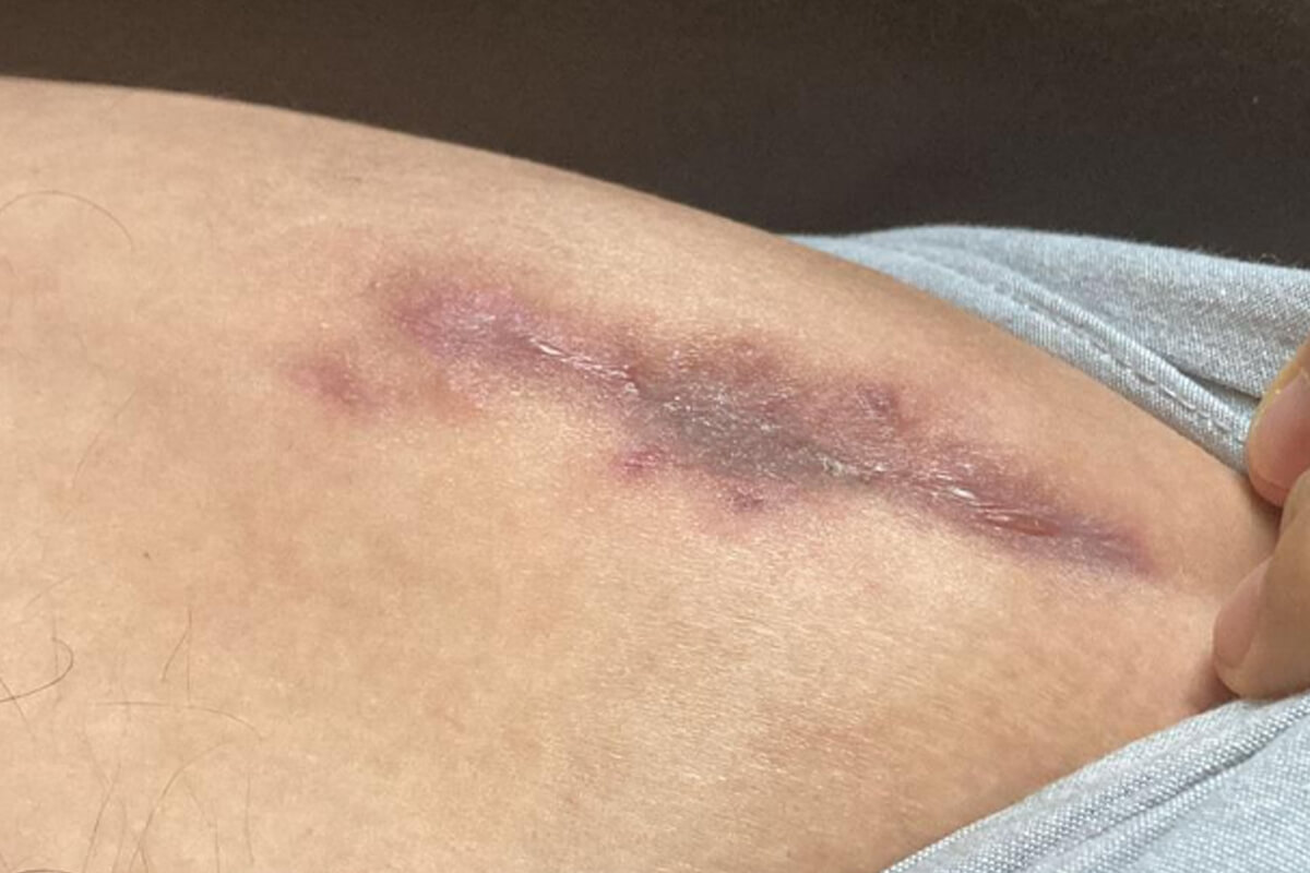 surgery scars in the lon method 1